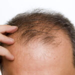 Hair Fall in Bhādon: Seasonal Causes and Natural Remedies