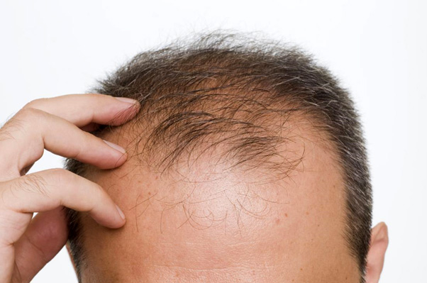 Hair Fall in Bhādon: Seasonal Causes and Natural Remedies