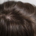 Say Goodbye to Itchy Scalp – Natural Solutions for Lasting Relief