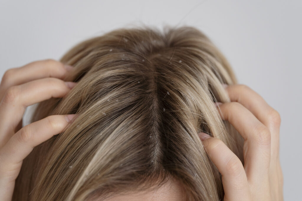 View of a woman with dandruff and frizzy hair, showing common scalp issues in humid weather.