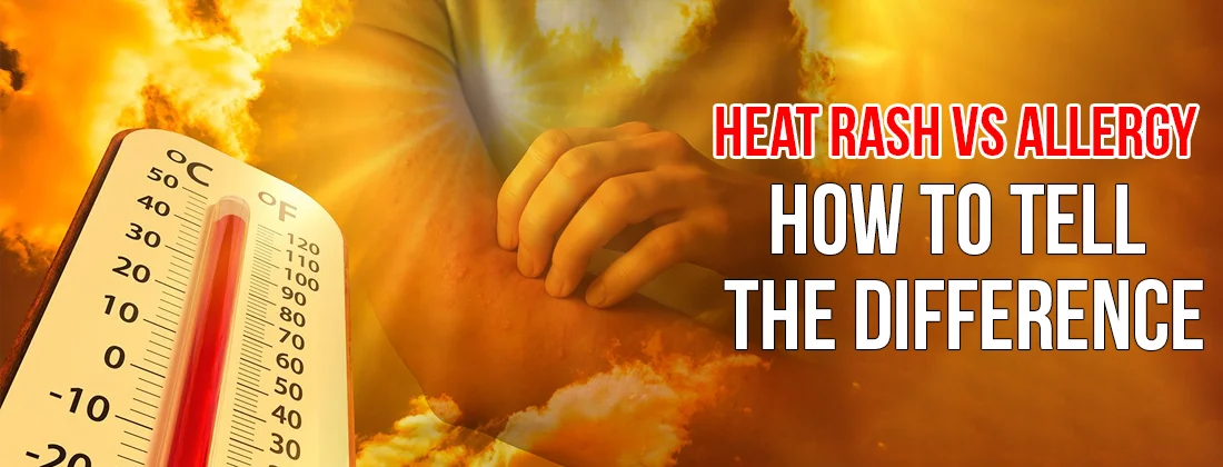 Heat Rash vs Allergy How to Tell the Difference